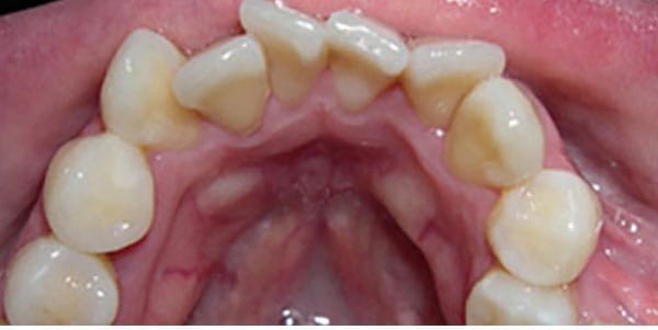 Before orthodontic treatment at Bhati Dental Clinic